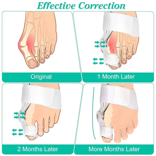 Bunion Toe Shaper - BUY 1 GET 1 FREE - Image 5